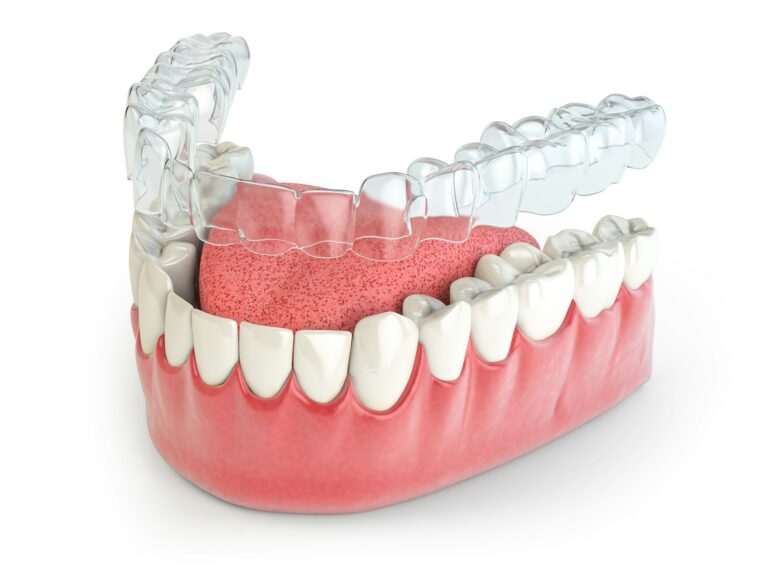 invisalign invisible retainer or braces with lawer jaw islated on white e1742941742107