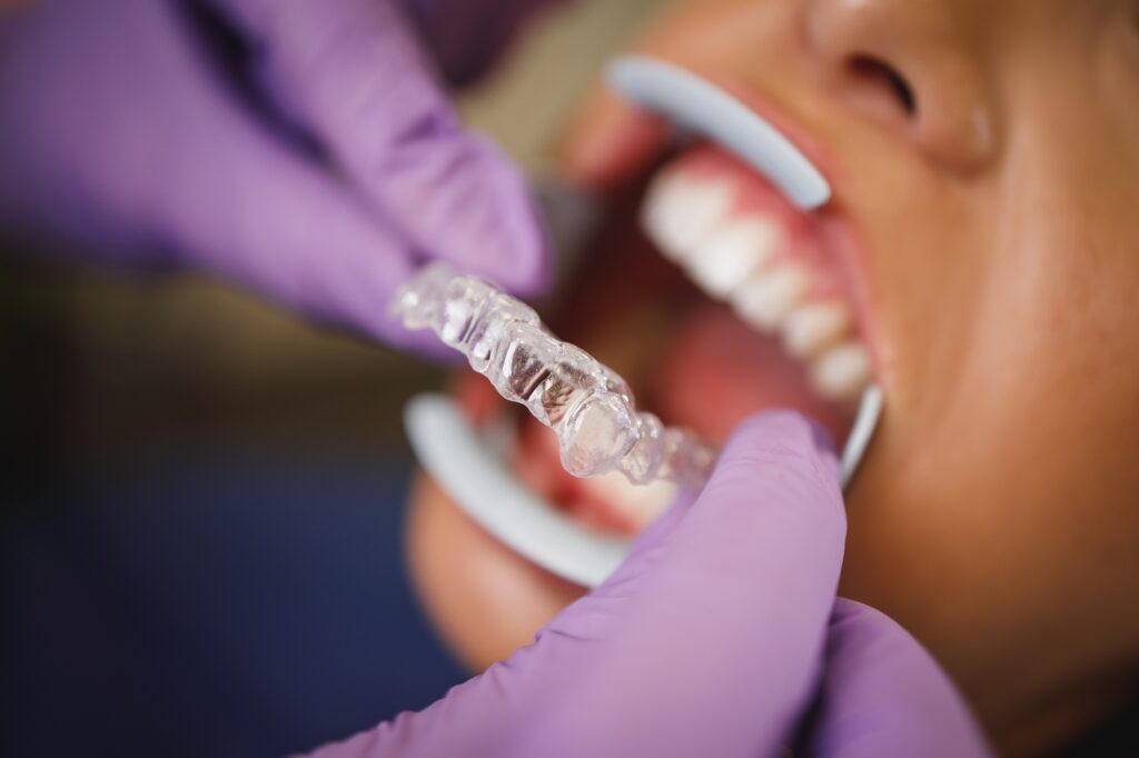invisalign braces