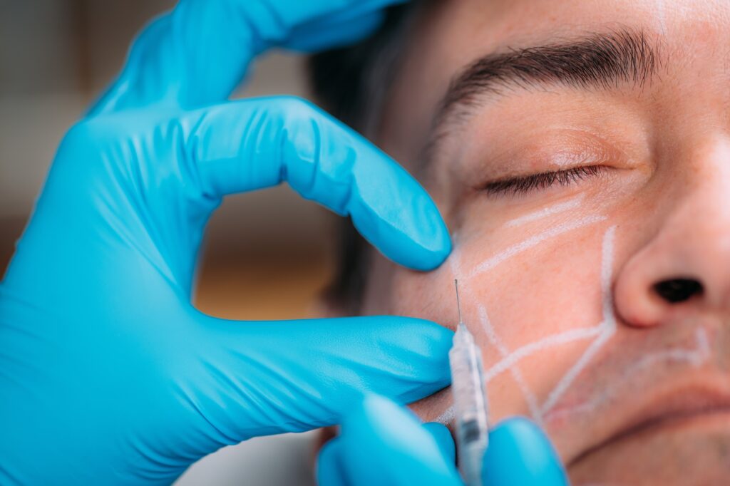 dermal filler injection men cheeks