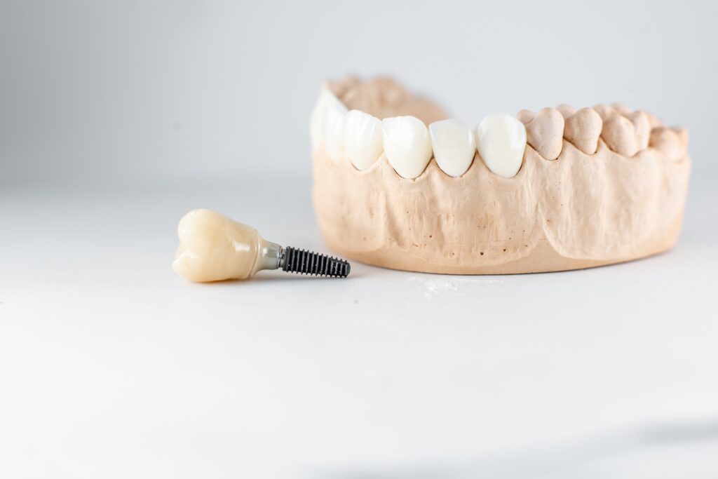 model of artificial jaw and dental implant