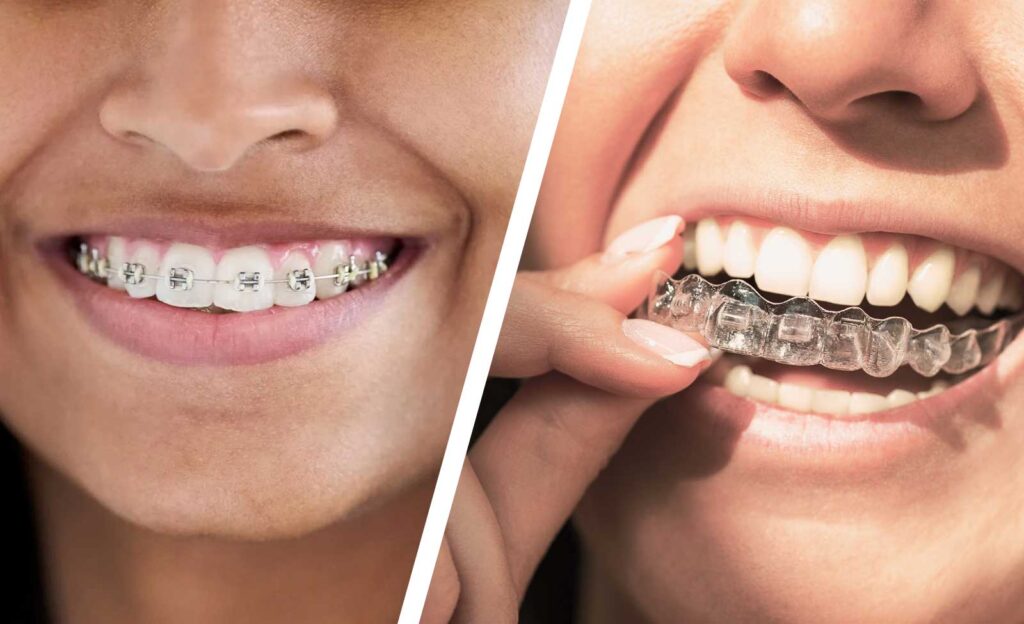 invisalign vs braces