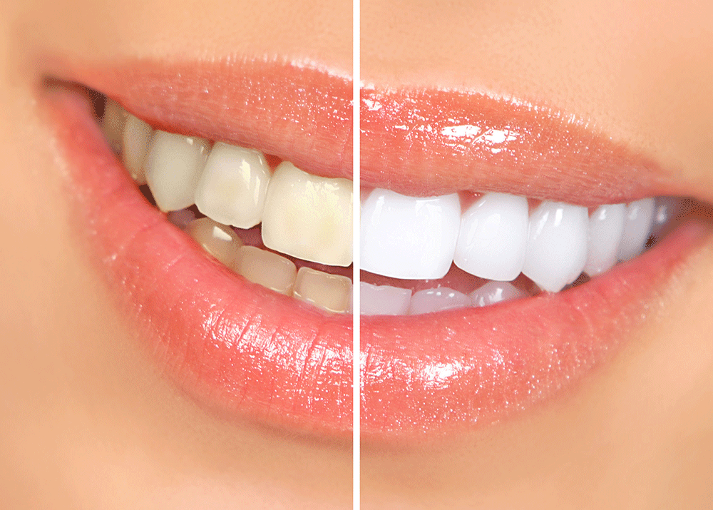 how does professional teeth whitening work
