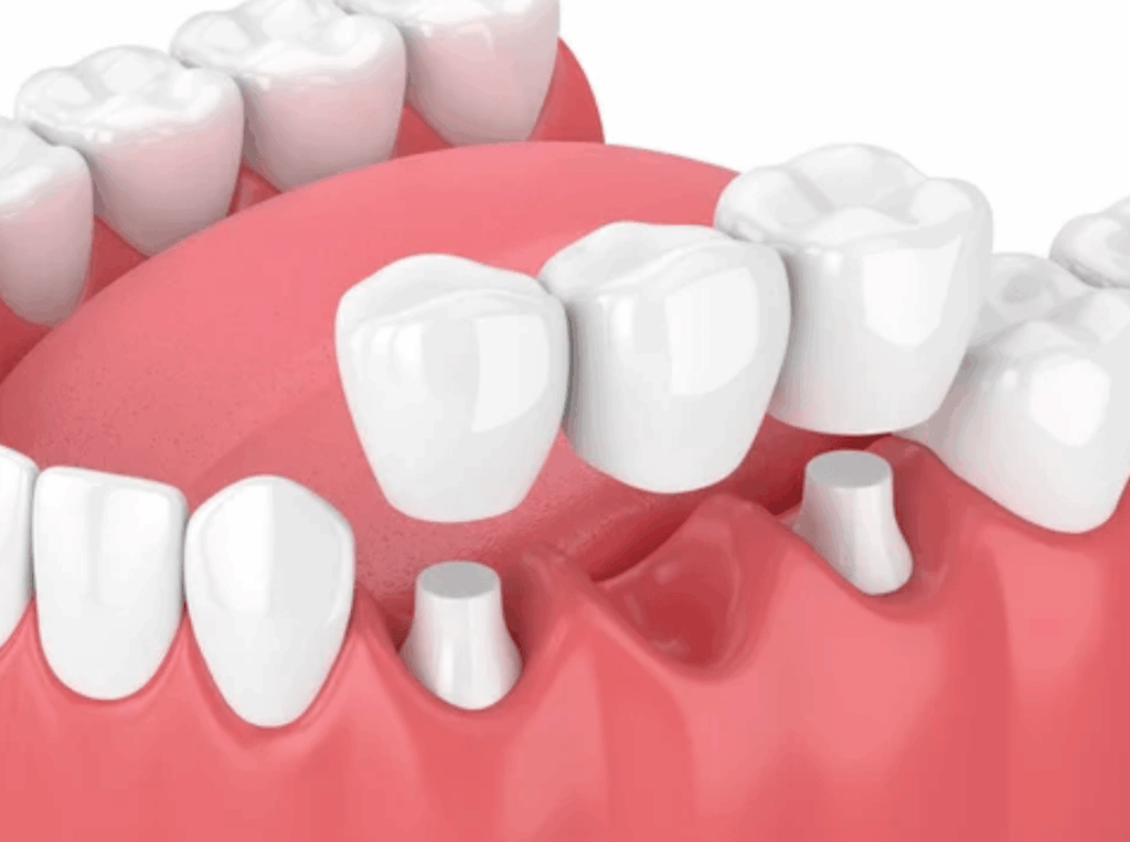 Dental bridge