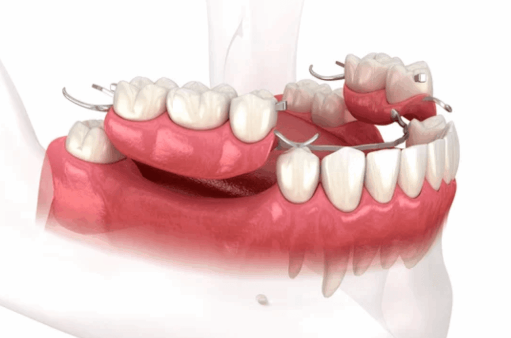 removable denture kansas missouri
