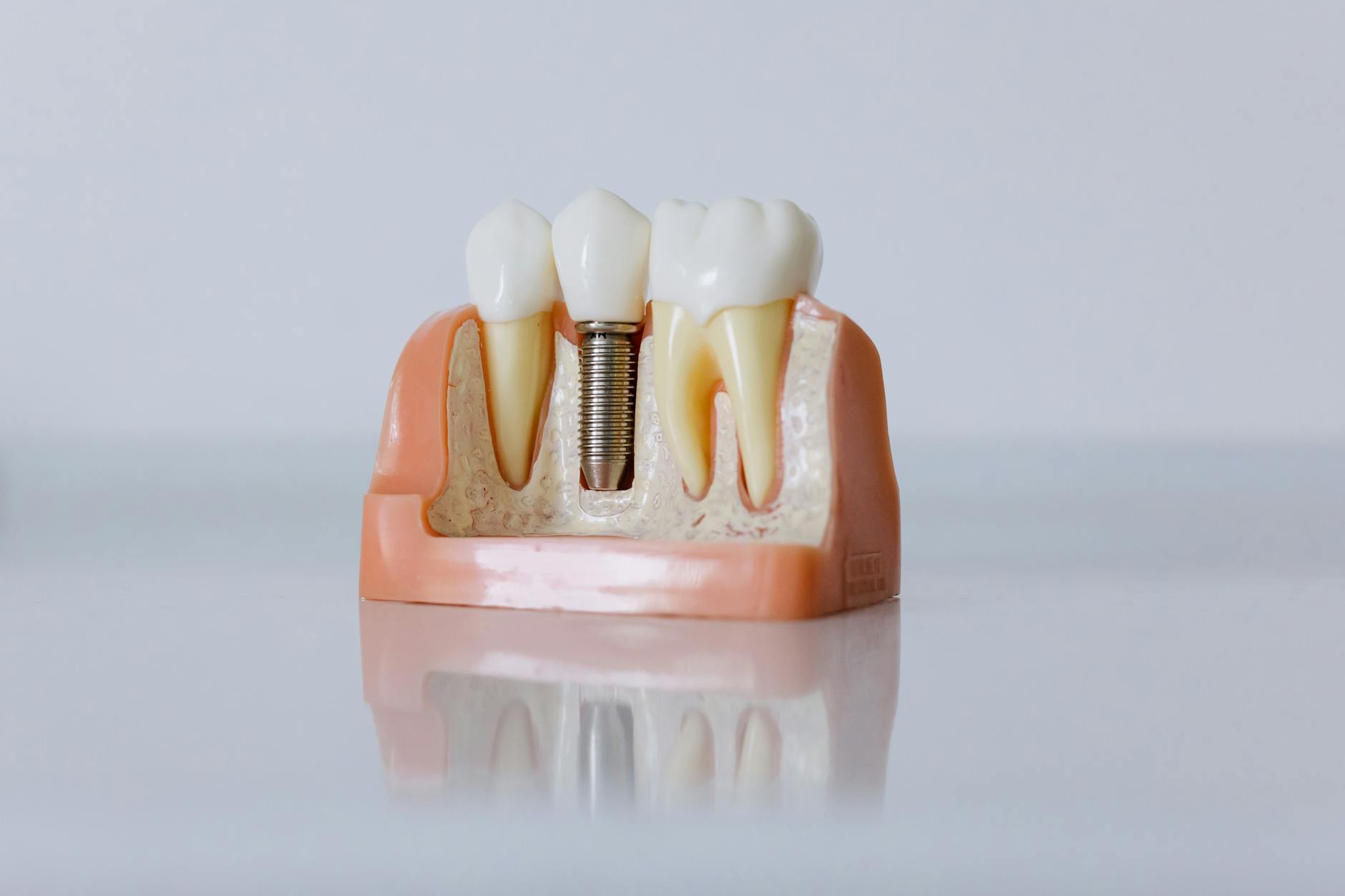 dental implant procedure tooth replacement surgery